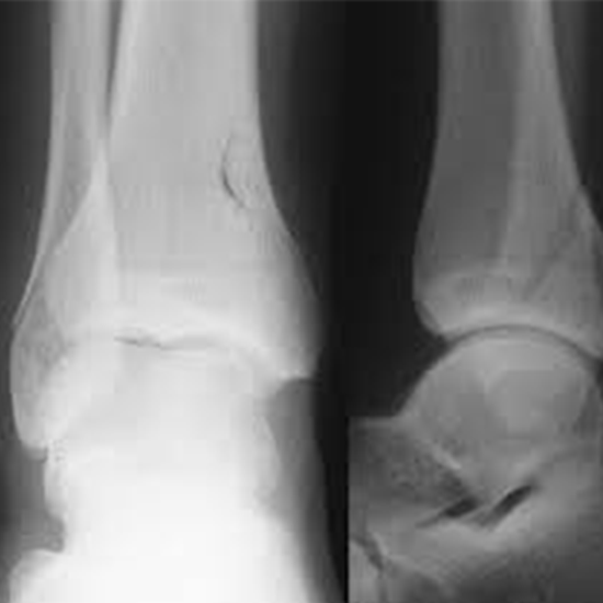 X-ray Right Ankle AP & Lateral